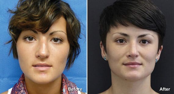 Rhinoplasty Before and After Photos in Princeton, NJ, Patient 554