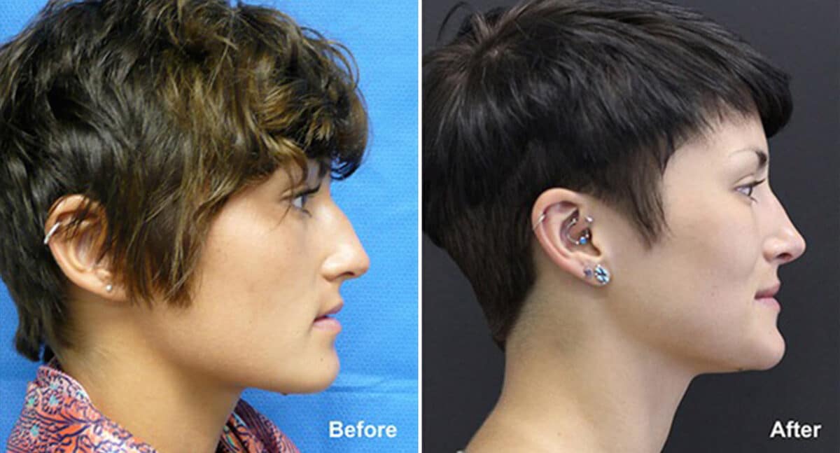 Rhinoplasty Before and After Photos in Princeton, NJ, Patient 554