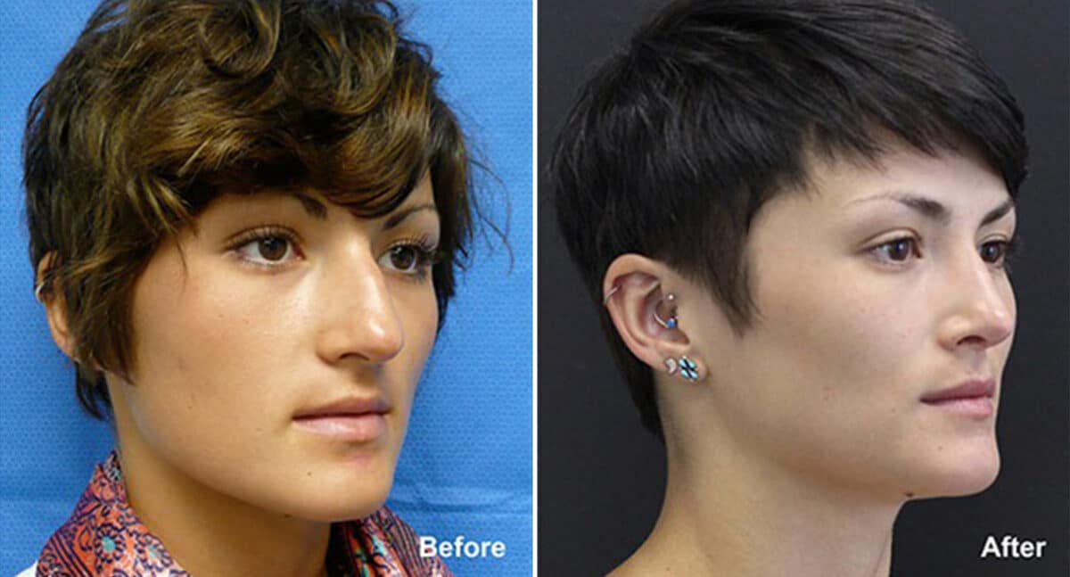 Rhinoplasty Before and After Photos in Princeton, NJ, Patient 554