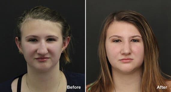 Rhinoplasty Before and After Photos in Princeton, NJ, Patient 564