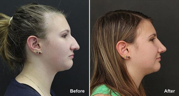 Rhinoplasty Before and After Photos in Princeton, NJ, Patient 564