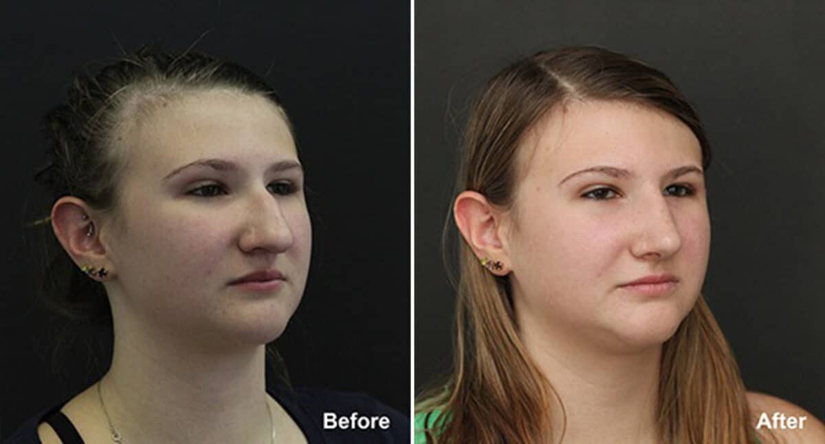 Rhinoplasty Before and After Photos in Princeton, NJ, Patient 564