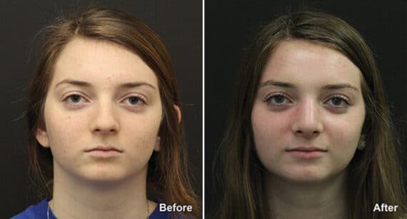 Rhinoplasty Before and After Photos in Princeton, NJ, Patient 574