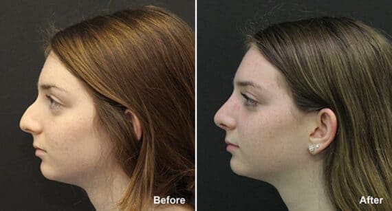 Rhinoplasty Before and After Photos in Princeton, NJ, Patient 574