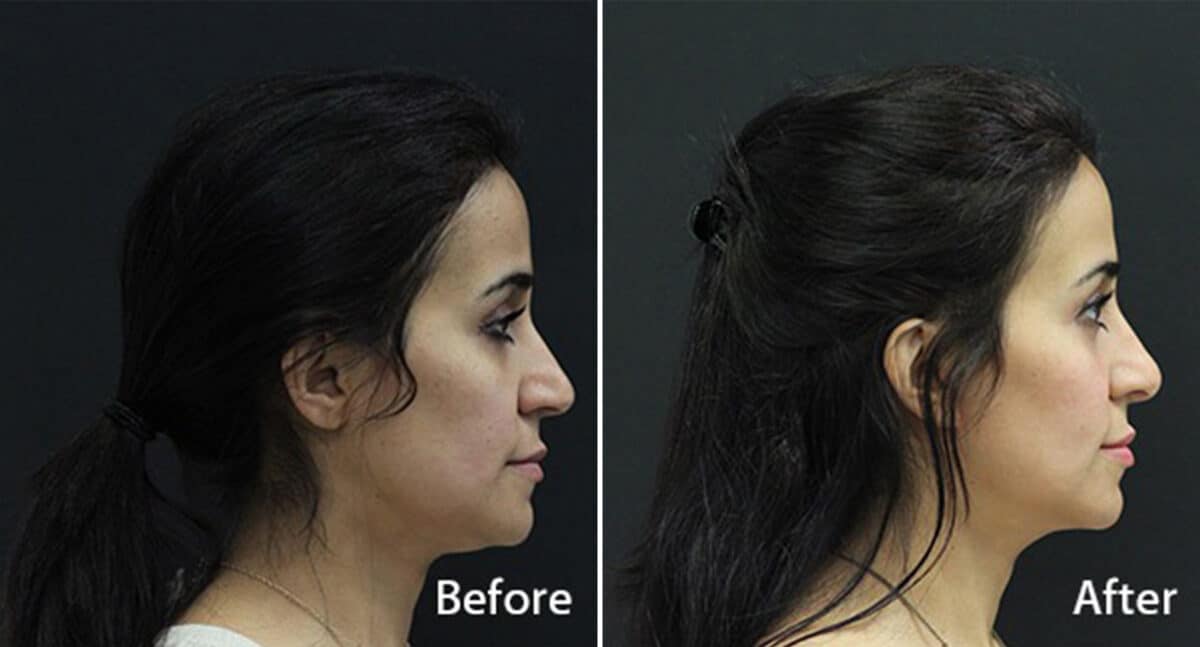 Rhinoplasty Before and After Photos in Princeton, NJ, Patient 581