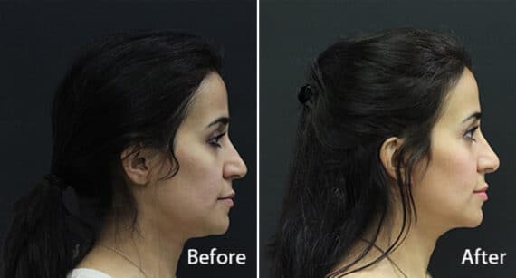 Rhinoplasty Before and After Photos in Princeton, NJ, Patient 581