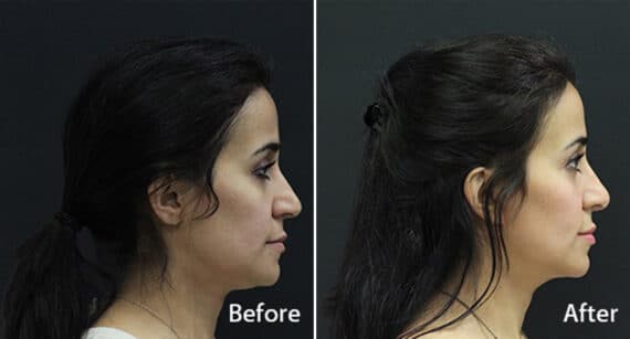 Rhinoplasty Before and After Photos in Princeton, NJ, Patient 581