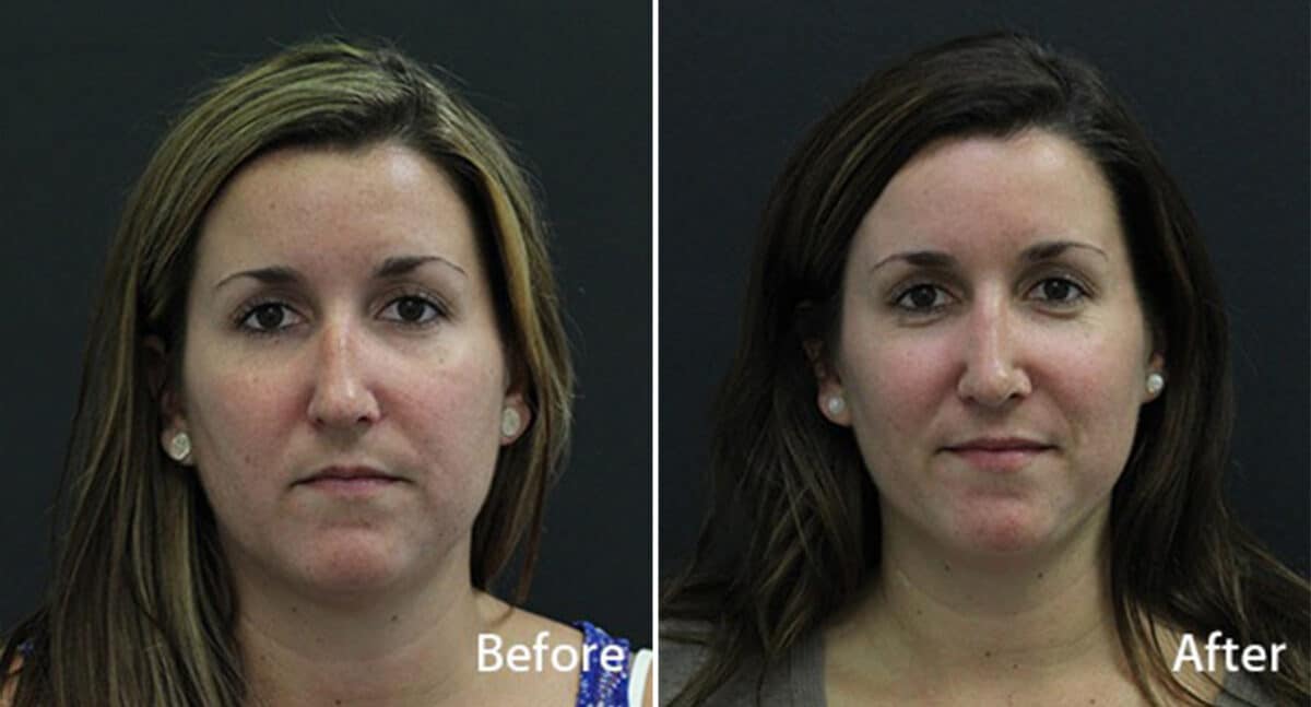 Rhinoplasty Before and After Photos in Princeton, NJ, Patient 591