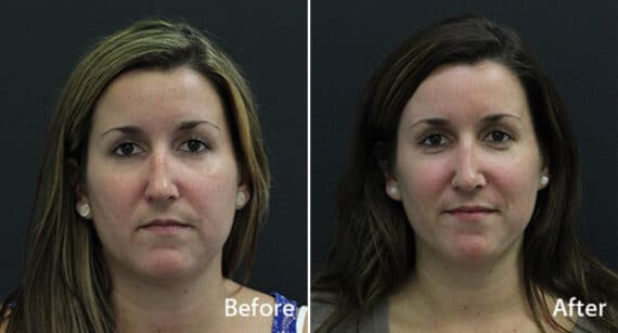 Rhinoplasty Before and After Photos in Princeton, NJ, Patient 591