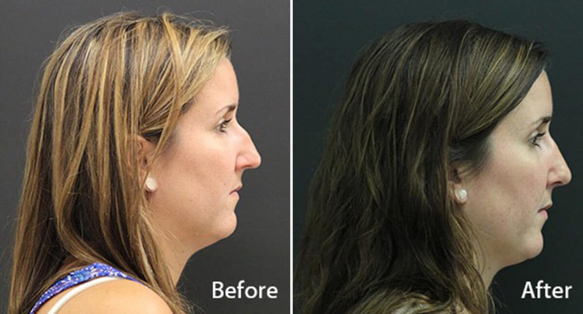 Rhinoplasty Before and After Photos in Princeton, NJ, Patient 591