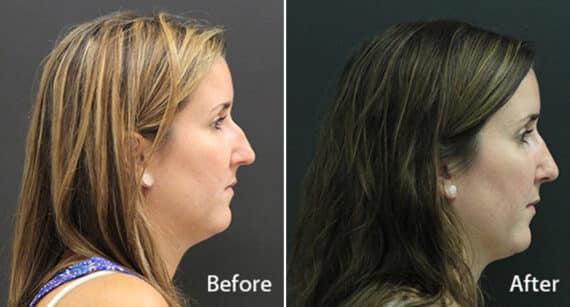 Rhinoplasty Before and After Photos in Princeton, NJ, Patient 591