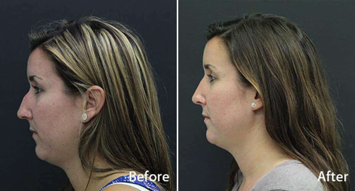 Rhinoplasty Before and After Photos in Princeton, NJ, Patient 591