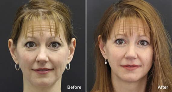 Rhinoplasty Before and After Photos in Princeton, NJ, Patient 601