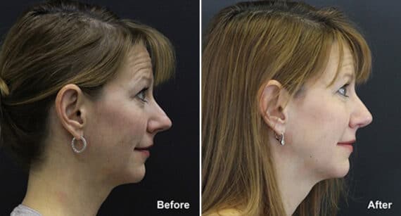 Rhinoplasty Before and After Photos in Princeton, NJ, Patient 601