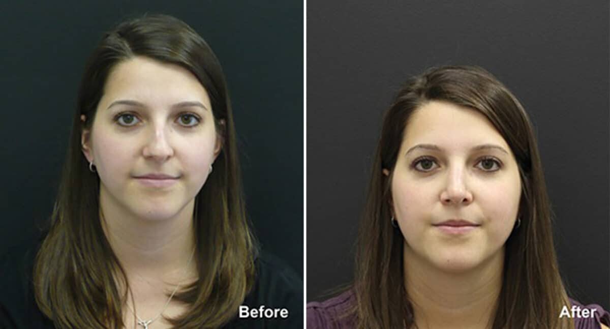 Rhinoplasty Before and After Photos in Princeton, NJ, Patient 611