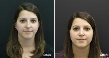 Rhinoplasty Before and After Photos in Princeton, NJ, Patient 611