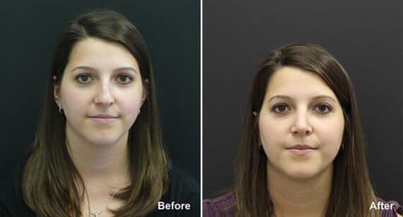 Rhinoplasty Before and After Photos in Princeton, NJ, Patient 611