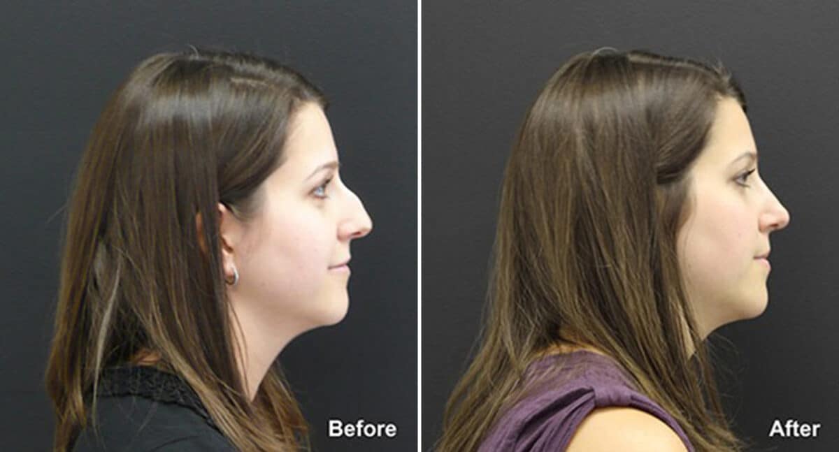 Rhinoplasty Before and After Photos in Princeton, NJ, Patient 611