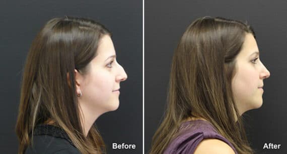 Rhinoplasty Before and After Photos in Princeton, NJ, Patient 611