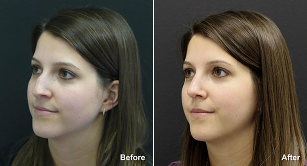 Rhinoplasty Before and After Photos in Princeton, NJ, Patient 611