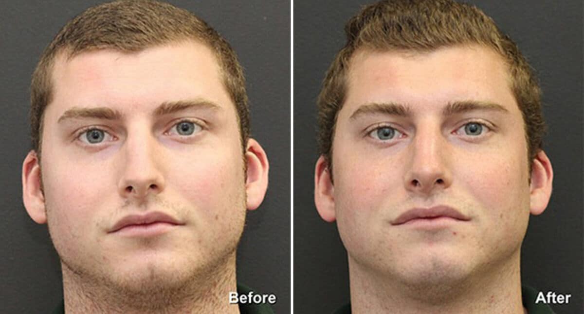 Rhinoplasty Before and After Photos in Princeton, NJ, Patient 621