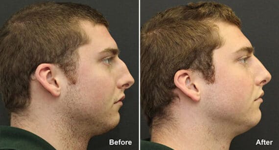 Rhinoplasty Before and After Photos in Princeton, NJ, Patient 621