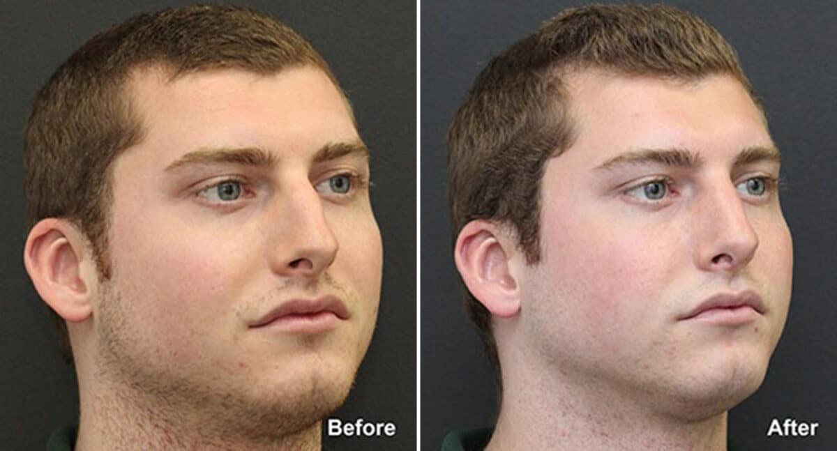 Rhinoplasty Before and After Photos in Princeton, NJ, Patient 621