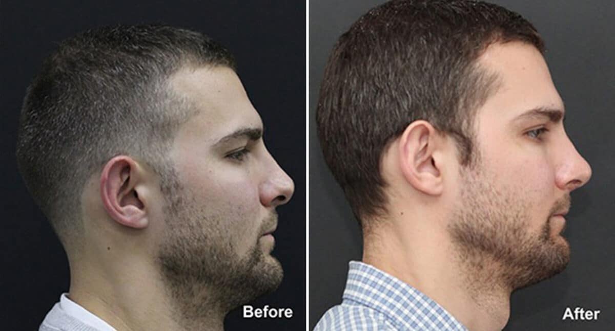 Rhinoplasty Before and After Photos in Princeton, NJ, Patient 631