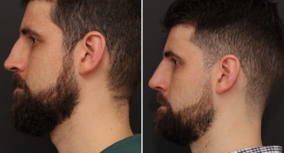 Rhinoplasty Before and After Photos in Princeton, NJ, Patient 641