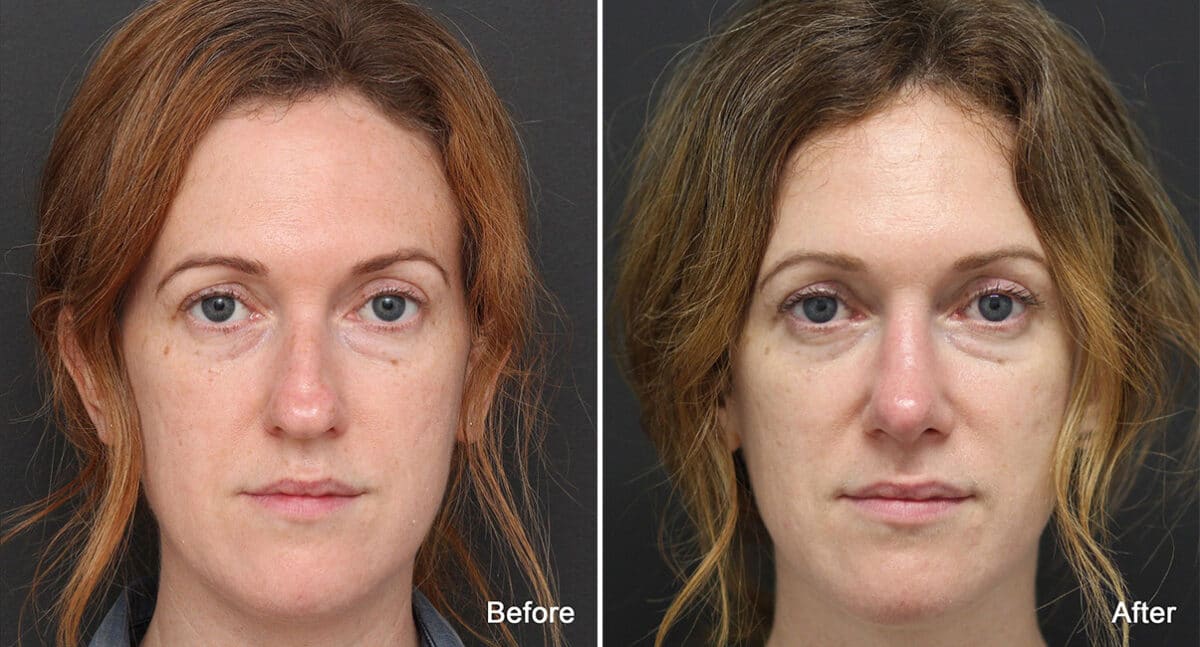 Rhinoplasty Before and After Photos in Princeton, NJ, Patient 651