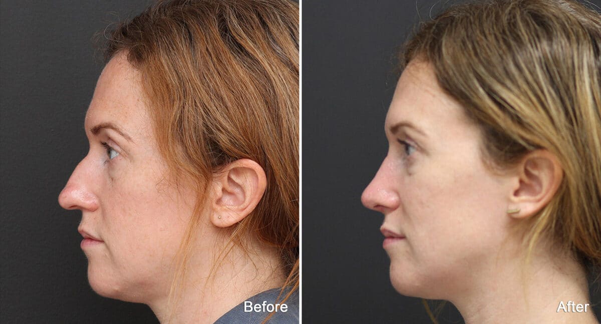 Rhinoplasty Before and After Photos in Princeton, NJ, Patient 651