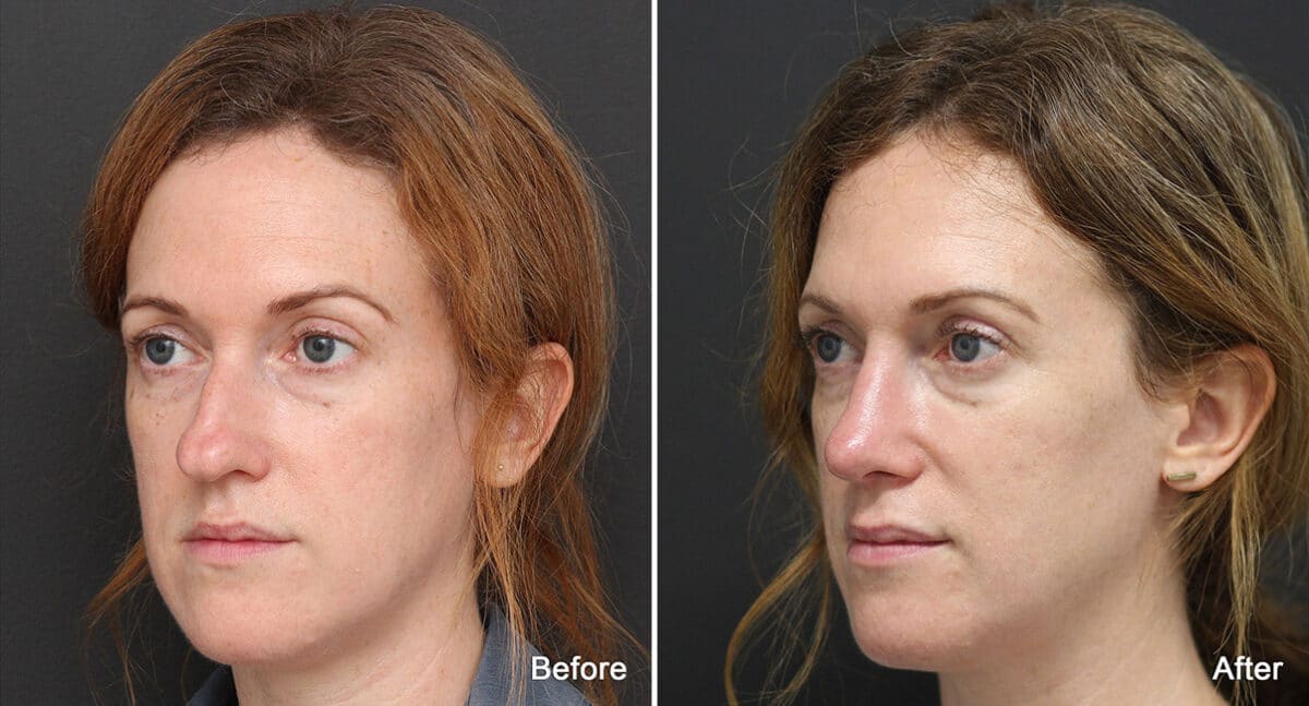 Rhinoplasty Before and After Photos in Princeton, NJ, Patient 651