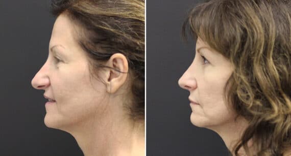 Rhinoplasty Before and After Photos in Princeton, NJ, Patient 661