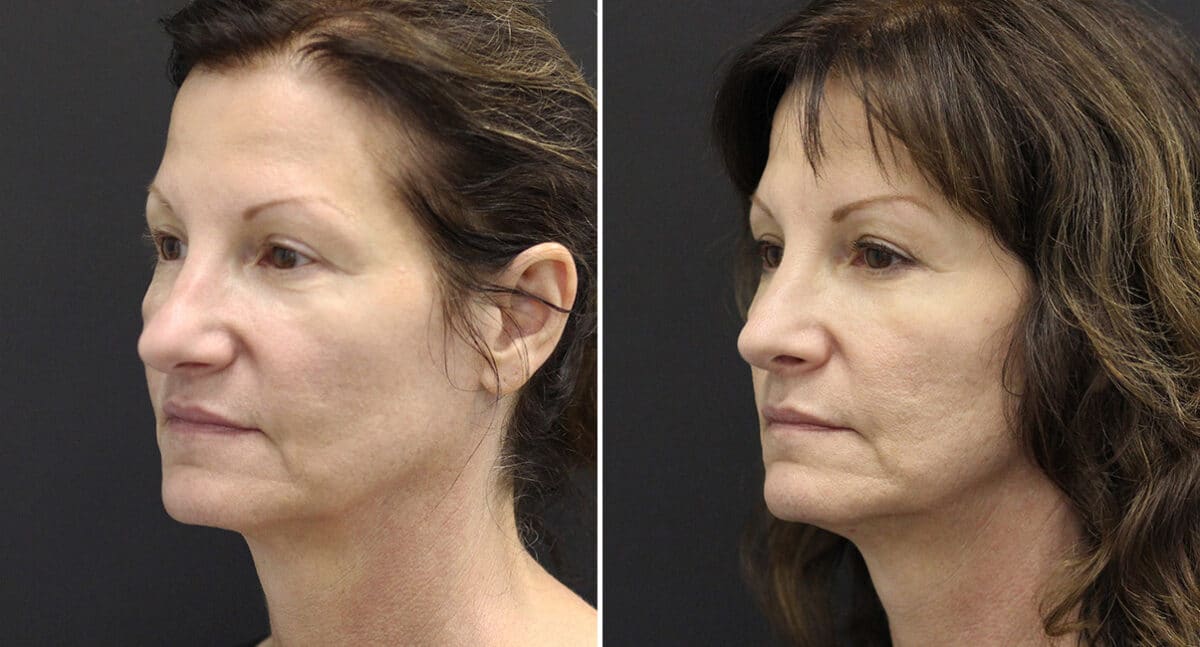 Rhinoplasty Before and After Photos in Princeton, NJ, Patient 661