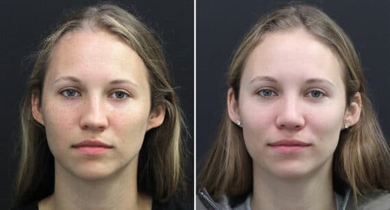 Rhinoplasty Before and After Photos in Princeton, NJ, Patient 671