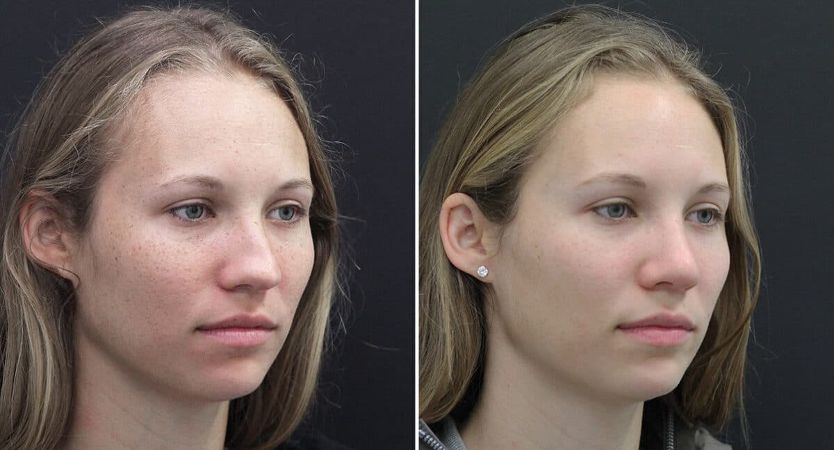 Rhinoplasty Before and After Photos in Princeton, NJ, Patient 671