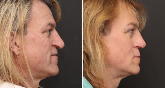 Rhinoplasty Before and After Photos in Princeton, NJ, Patient 681