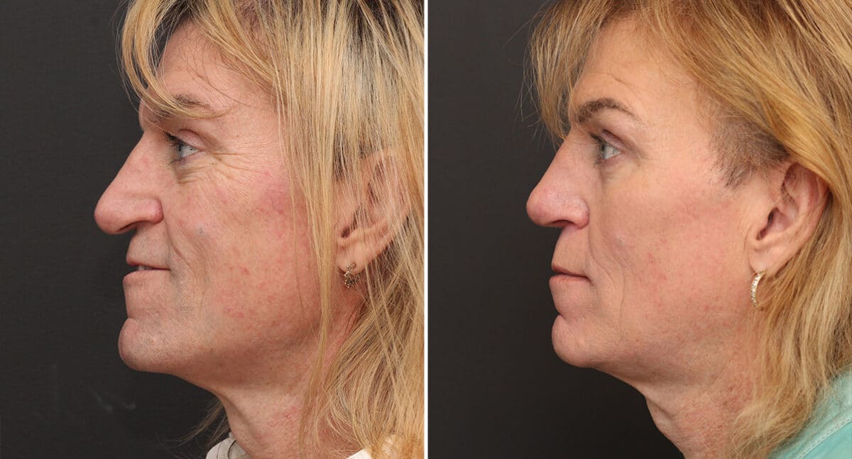 Rhinoplasty Before and After Photos in Princeton, NJ, Patient 681