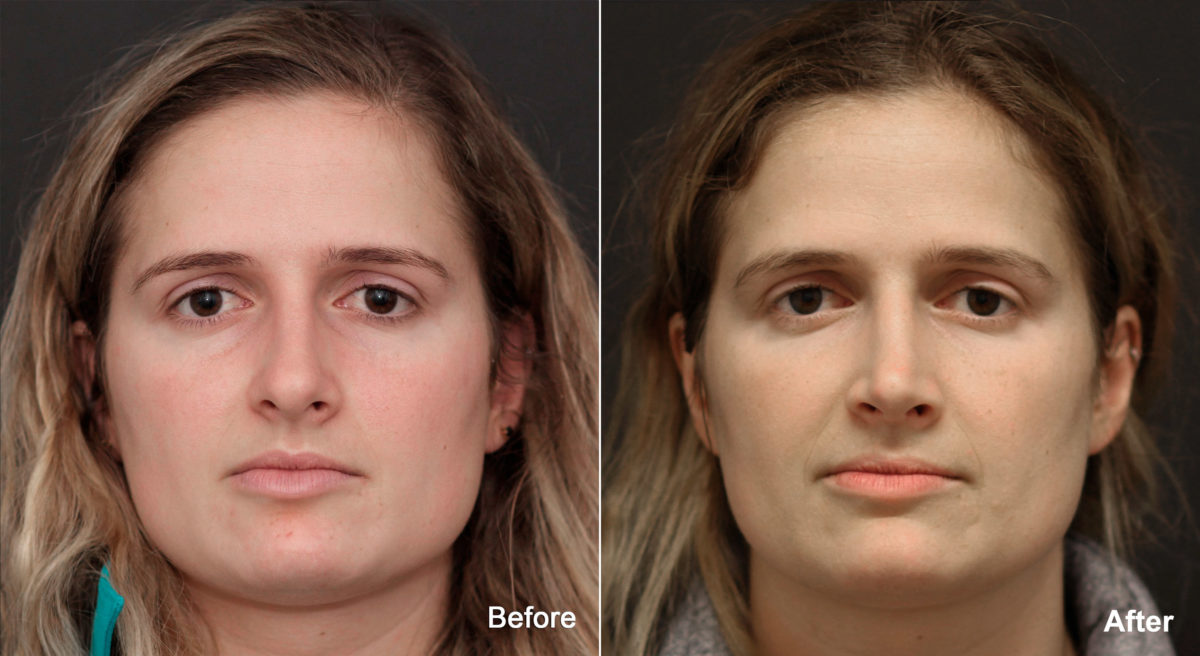 Rhinoplasty Before and After Photos in Princeton, NJ, Patient 691