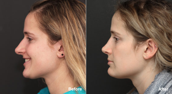 Rhinoplasty Before and After Photos in Princeton, NJ, Patient 691