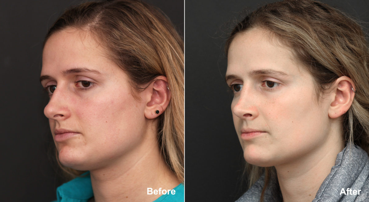 Rhinoplasty Before and After Photos in Princeton, NJ, Patient 691