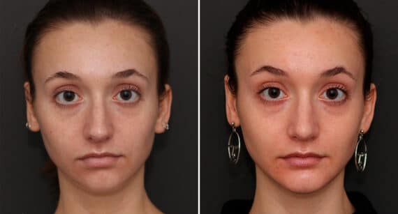 Rhinoplasty Before and After Photos in Princeton, NJ, Patient 701