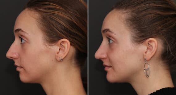 Rhinoplasty Before and After Photos in Princeton, NJ, Patient 701