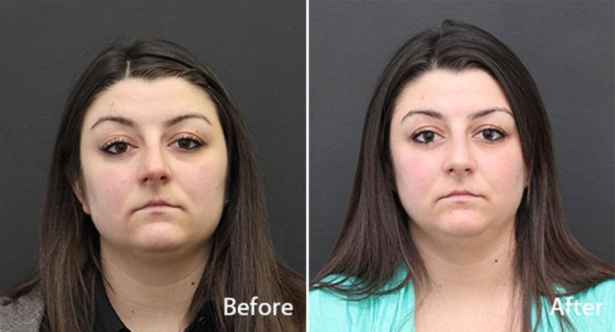 Rhinoplasty Before and After Photos in Princeton, NJ, Patient 708