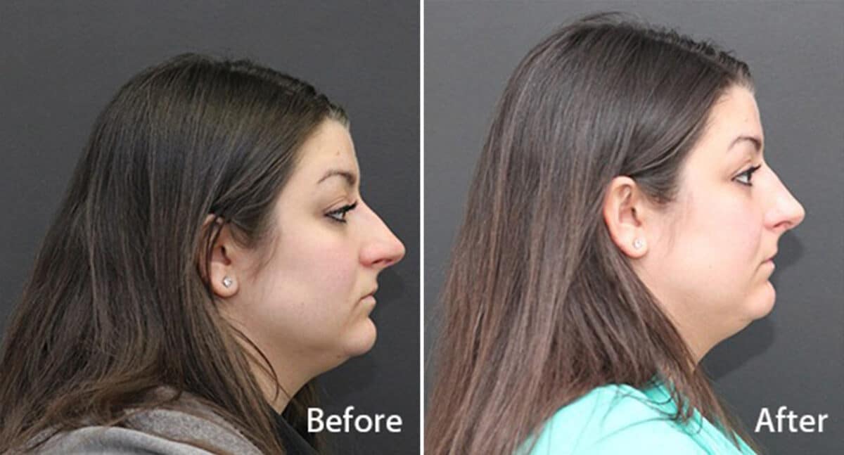 Rhinoplasty Before and After Photos in Princeton, NJ, Patient 708