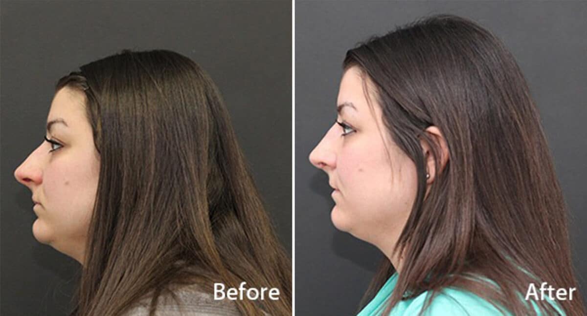 Rhinoplasty Before and After Photos in Princeton, NJ, Patient 708