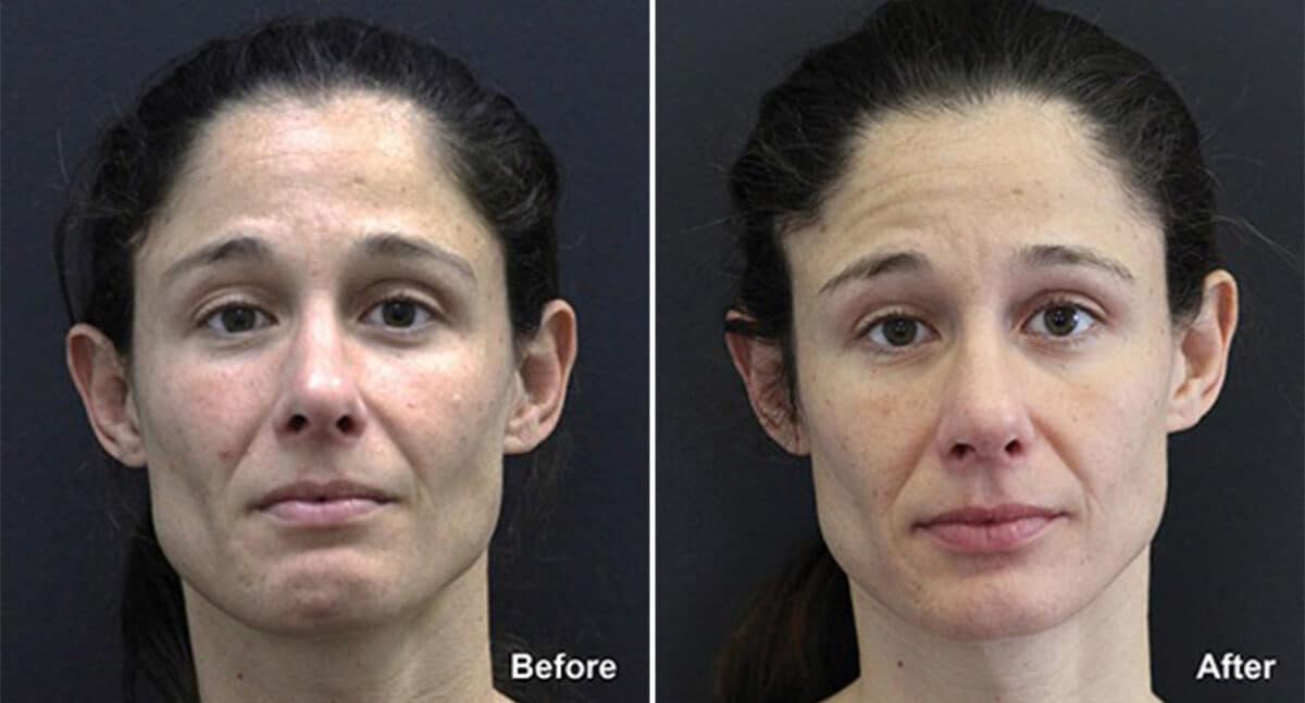 Patient 718, Rhinoplasty Before and After Photos Rhinoplasty Before and After Photos in Princeton, NJ, Patient 718
