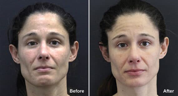 Rhinoplasty Before and After Photos in Princeton, NJ, Patient 718