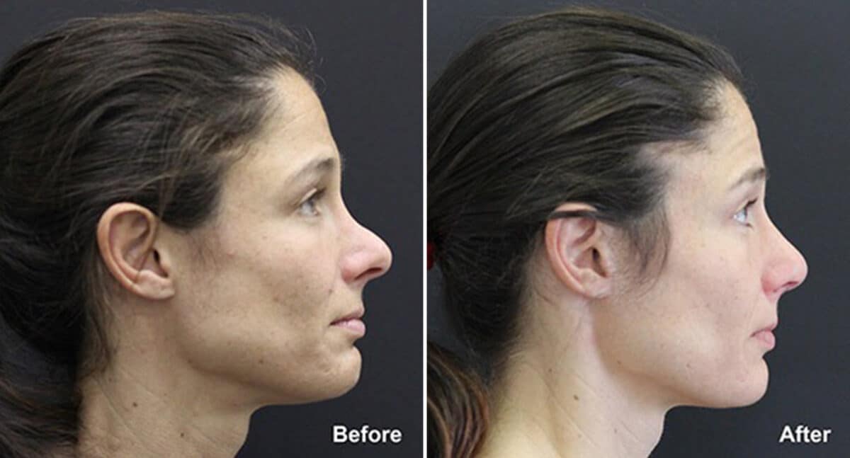 Patient 718, Rhinoplasty Before and After Photos Rhinoplasty Before and After Photos in Princeton, NJ, Patient 718