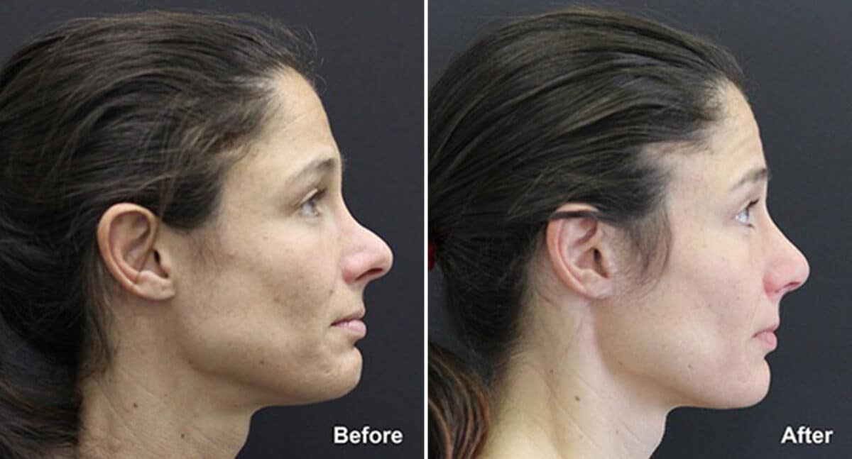 Rhinoplasty Before and After Photos in Princeton, NJ, Patient 718